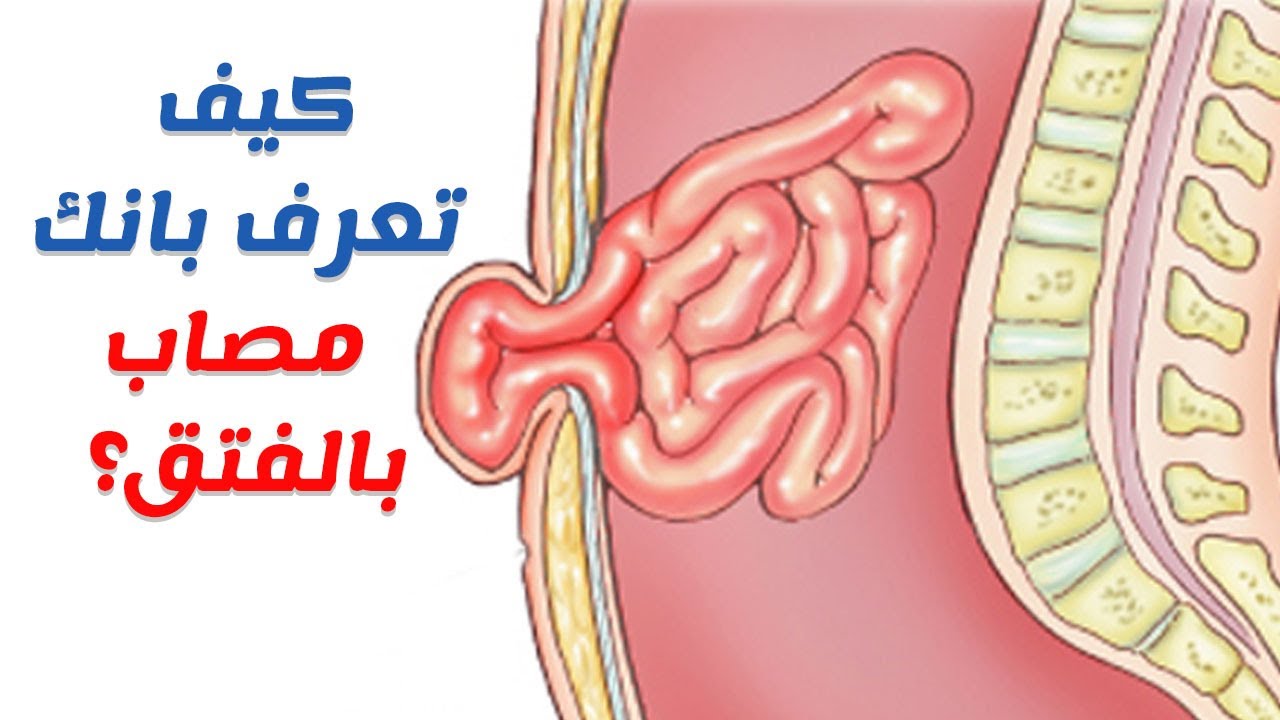 كيف تعرف أنك مصاب بـ «الفتق»؟!